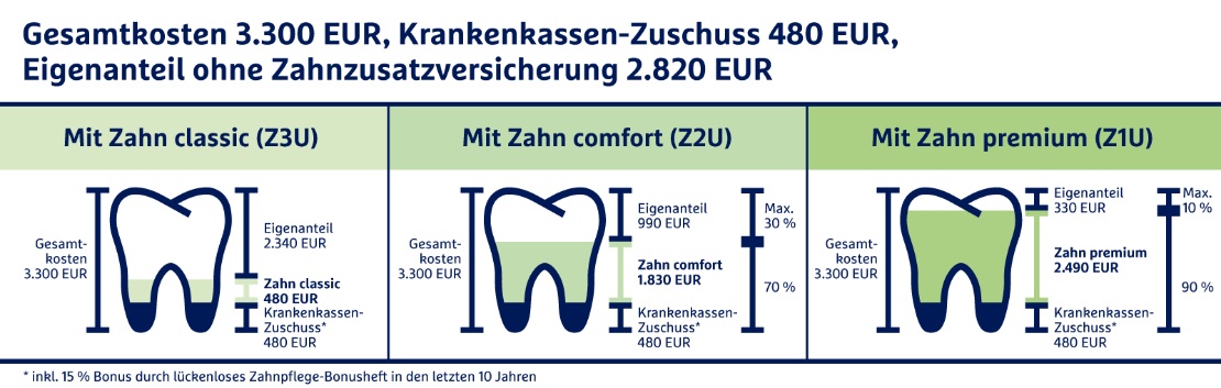 Beispielrechnung für ein Implantat: Gesamtkosten 3.300 EUR, Krankenkassen-Zuschuss 480 EUR, Eigenanteil ohne Zahnzusatzversicherung 2.820 EUR im Tarif Zahn classic beträgt der Eigenanteil nur noch 2.340 EUR, im Tarif Zahn comfort beträgt der Eigenanteil nur noch 990 EUR, im Tarif  Zahn premium beiträgt der Eigenanteil nur noch 330 EUR.